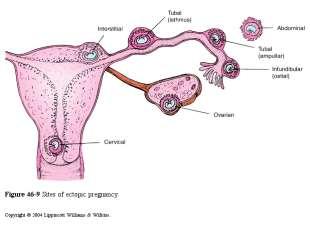 The Fallopian Tubes Ectopic Pregnancy = Frequency of 2% among females.
