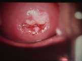 Vaginal warts Cervical cancer stages Cervical warts Oral/throat