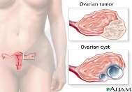 Polycystic Ovarian Syndrome = follicles in ovary fill with fluid (cysts). Painful condition that decreases fertility.