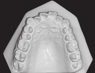 dental casts.