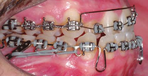 Figure 6 - Intraoral photographs when maxillary and mandibular incisors