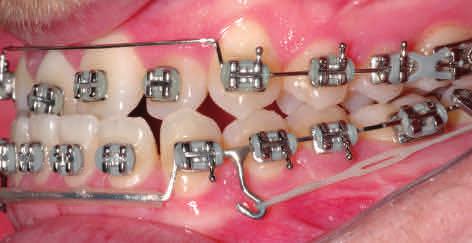Anterior crossbite was successfully corrected and adequate overjet and