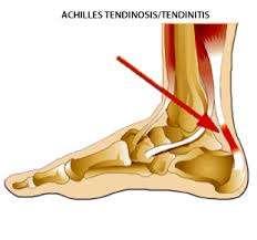 Diagnosis: Achilles Tendinitis ( tegelikult tuleks see asendada - Tendinosis ) What is Achilles Tendinitis?