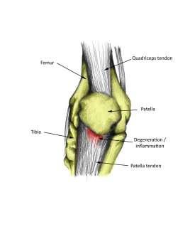 chondropathia What is Jumpers knee? Patellar tendinitis (patellar tendinopathy, also known as jumper's knee), is a relatively common cause of pain at the apex of patella in athletes.