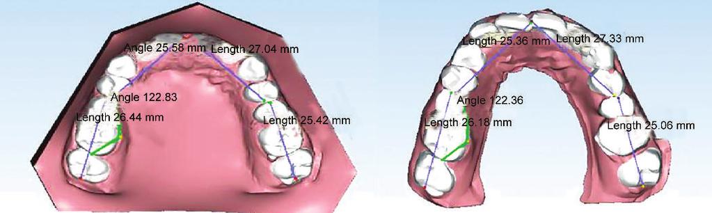 WJD Modeling and Printing of Successive Misaligned Teeth Stages (Cont d ) Stage 4 18 0 0 0 0.2 0 0 17 0 0 0 0.5 0.6 0.5 16 0 0 0 2 0 0.3 15 0 0 0 0.6 0 0.2 14 0 0 0 1.9 0.4 0.3 13 0 4 0 0.29 0.41 0.
