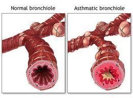 Asthma A chronic respiratory disease characterized by inflammation