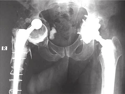 The purpose of this study was to analyze the early clinical and radiographic results obtained in a consecutive series of 18 cases with acetabular defects in revision total hip arthroplasty