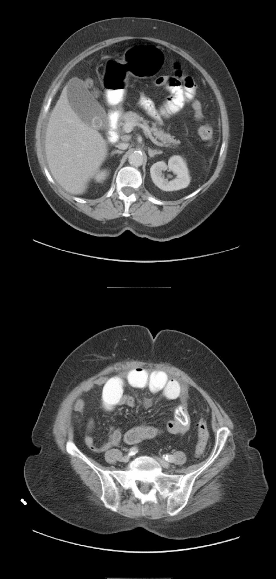 Saurabh et al. 2 CASE REPORT Patient 1: A 75 year old female presented with a three day history of diffuse abdominal pain, distension, nausea and vomiting.
