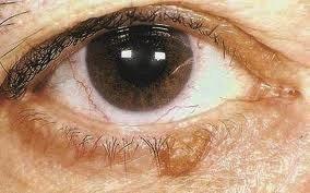 Benign Eyelid Lesions: Seborrheic Keratosis Color varies from tan to