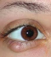 Benign Eyelid Lesions: Chalazia May drain spontaneously or persist as a chronic nodule Recurrent lesions need to exclude a