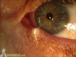 Benign Eyelid Lesions: Epidermal Inclusion Cyst May become infected or may rupture Differentials