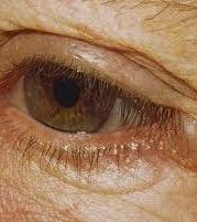 Benign Eyelid Lesions: Apocrine Hidrocystoma Do not increase in size in