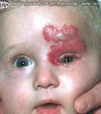 Benign Eyelid Lesions: Capillary Hemangioma Recent evidence supports the use