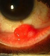 Benign Eyelid Lesions: Pyogenic Granuloma Differential include Kaposi s sarcoma Treatment can