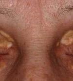 Benign Eyelid Lesions: Composed of foamy, lipidladen xanthoma cells clustered around blood vessels and adnexal tissue within the