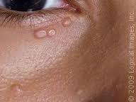 Benign Eyelid Lesions: Molluscum Contagiosum Common viral skin disease caused by a large DNA pox virus Infection usually from direct contact in children