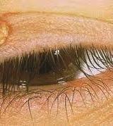 Benign Eyelid Lesions: Verruca Lesions along lid margin may cause papillary conjunctivitis