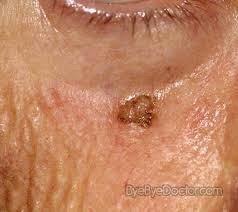 Pre-Malignant Eyelid Lesions: Actinic Keratosis Appear as
