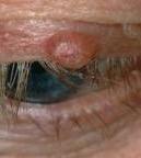 Malignant Eyelid Lesions: Basal Cell Carcinoma Definitive diagnosis made on histopathological examination of biopsy specimens loss of adjacent cilia is strongly