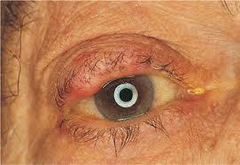 only 3% of eyelid malignancies, most common eyelid malignancy in Asian Indian
