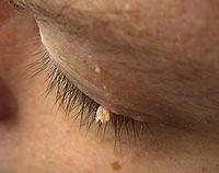 Benign Eyelid Lesions: Squamous Papilloma Flesh colored and