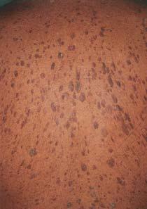 Common skin tumors Topic Benign epidermal tumors Skin cyst and adnexal neoplasms Other common skin tumor Common skin malignancy สมศ กด ต นร ตนากร 26/02/2015 Benign Epidermal Tumors