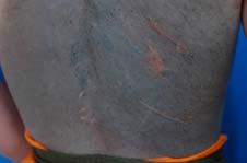 Junctional dark brown macule