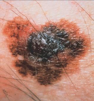 Type of melanoma Freq.