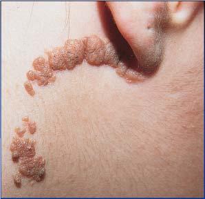 papules or plaques