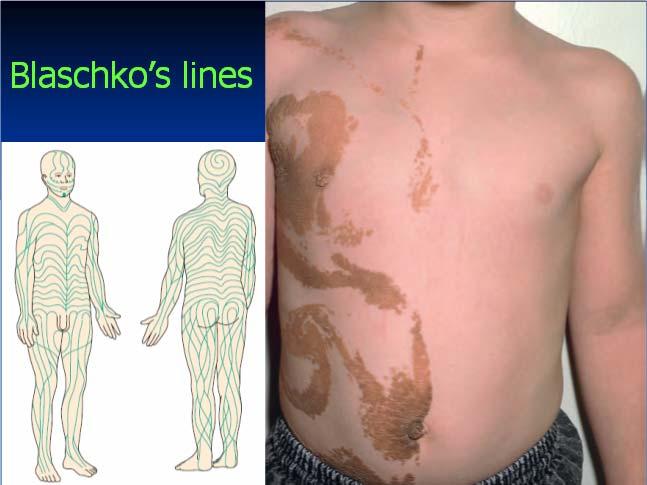 Blaschko s lines Inflammatory