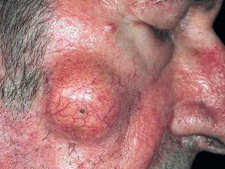 mucous cyst Ganglion Epidermoid (Epithelial)