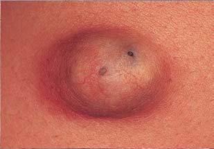 common cutaneous cysts occur anywhere but