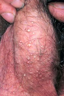 Clinical = epidermal cyst