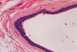 Digital mucous cyst Ganglion Apocrine hidrocystoma 1-3 mm