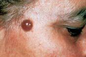face adenomas of apocrine sweat gland coils Eccrine