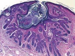 Trichoepithelioma skin-colored papule