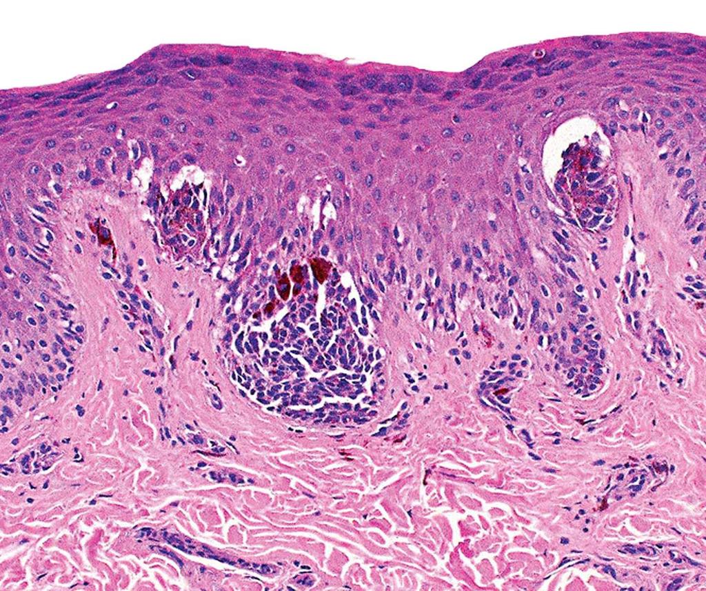Microscopic:- Junctional nevi: Nests of round to oval cells, growing along the dermoepidermal