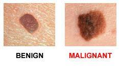 Melanoma: A malignant tumor, its incidence is highest in areas where