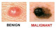 Gross: A nodule, with striking variations in pigmentation, including