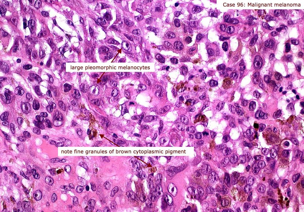 Melanoma cells are large, epithelioid-like or spindle, having large nuclei, with