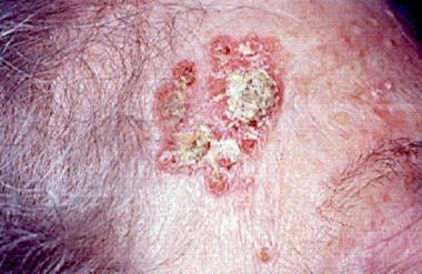 Bowen s disease: (Squamous cell carcinoma in-situ) Gross: