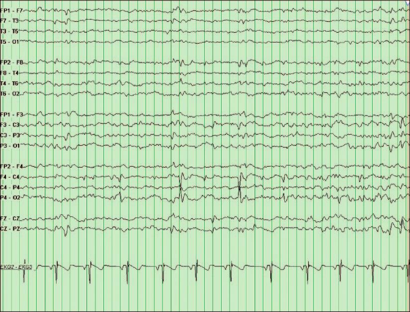 Figure 4. EEG tracing showing a right centroparietal spike (spikes observed in P4-O2, C4-P4, and F4-C4 leads) in a 12-year-old girl who has partial epilepsy.
