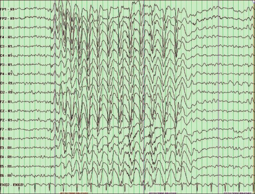 Figure 5. EEG tracing showing a generalized 3-Hz spike and wave discharge lasting 6 seconds in a 7-year-old girl who has generalized absence epilepsy.