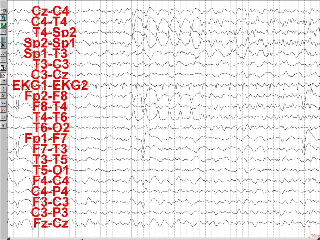 EEG: Partial Seizure Right temporal seizure with