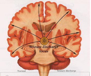 Myoclonic Seizures! Brief, shock-like jerk of a muscle or group of muscles!