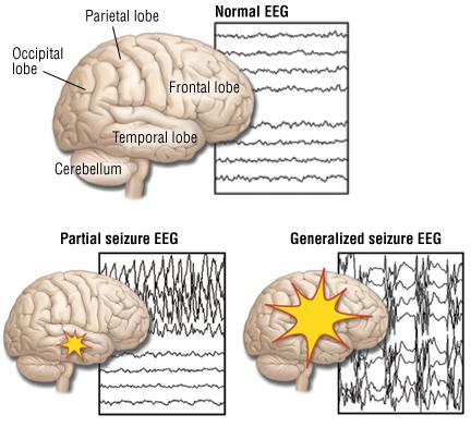 Resources for the Diagnosis of Epilepsy EEG (ElectroEncephaloGraphy) Electroencephalography is a measurement of the