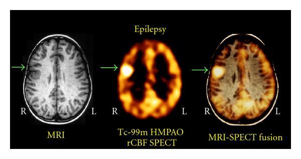 Resources for the Diagnosis of Epilepsy MRI