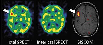 Resources for the Diagnosis of Epilepsy Ictal SPECT (Single Photon Emission Computed Tomography) SPECT scans show brain function (what the