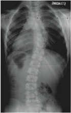Financial Disclosures Vertebral body stapling in children with idiopathic scoliosis < 10 years of age with curve magnitude 30-39 degrees Alexander A.