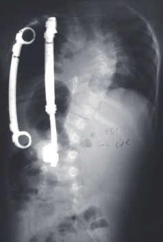 J Bone Joint Surg Am 1979;61:320 9. 6. Laituri CA, Schwend RM, Holcomb GW, 3rd. Thoracoscopic vertebral body stapling for treatment of scoliosis in young children.